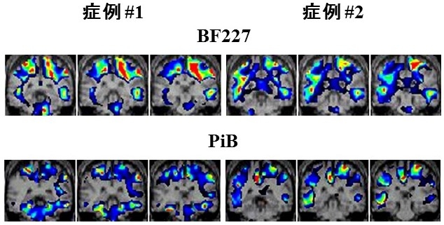 図：PET検査eZiS結果画像